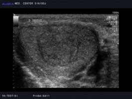 Ultrazvok testisov - tumor desnega testisa, najverjetneje seminom
